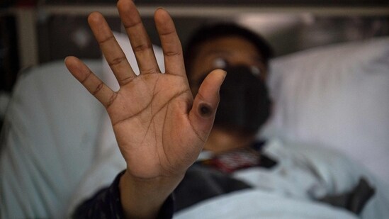 A patient shows his hand with a sore caused by an infection of the monkeypox virus in the isolation area for monkeypox patients at the Arzobispo Loayza hospital, in Lima.&nbsp;(AFP)