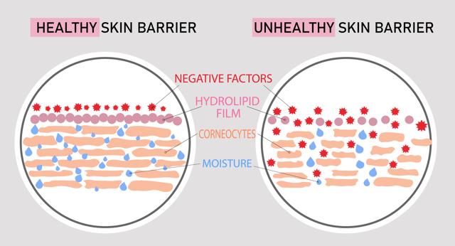 The difference between a healthy and unhealthy skin barrier (Shutterstock) The difference between a healthy and unhealthy skin barrier (Shutterstock)