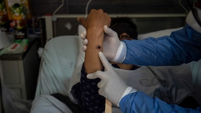 A doctor checks on a patient with sores caused by a monkeypox infection in the isolation area for monkeypox patients. (Photo by Ernesto BENAVIDES / AFP)