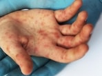 There are no disease-specific medications available for tomato flu. There are no disease-specific medications available for tomato flu.