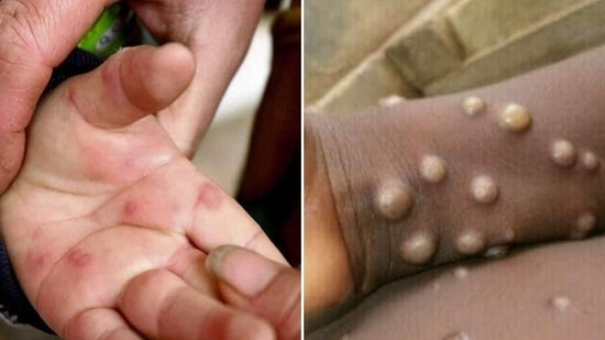 Monkeypox vs tomato flu: Like monkeypox, patients infected with tomato flu too develop skin rashes, fever and influenza like symptoms.