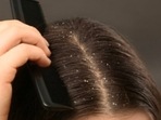 Easy ways to get rid of dandruff (Twitter/Simpfr2) Easy ways to get rid of dandruff (Twitter/Simpfr2)