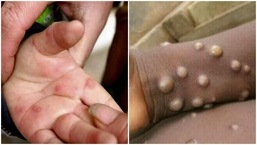Monkeypox normalmente requer contato pele a pele ou pele a boca com as lesões de um paciente infectado para se espalhar.  (imagem do arquivo)