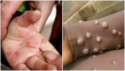 Monkeypox usually requires skin-to-skin or skin-to-mouth contact with an infected patient's foci to spread.  (file image)