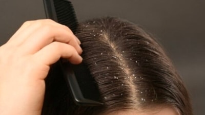 Easy ways to get rid of dandruff (Twitter/Simpfr2) Easy ways to get rid of dandruff (Twitter/Simpfr2)