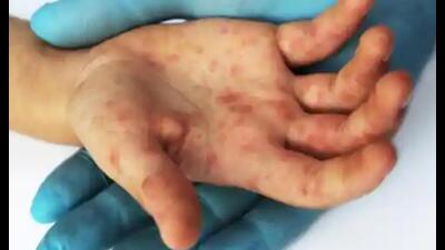 The disease occurs mainly in children under 10 years of age, but it can occur in adults too. (Pic for representation) The disease occurs mainly in children under 10 years of age, but it can occur in adults too. (Pic for representation)