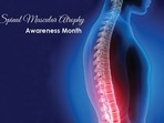 Spinal Muscular Atrophy Awareness Month: Symptoms of SMA, tips to diagnose it (Twitter/WrldwideLifeSci) Spinal Muscular Atrophy Awareness Month: Symptoms of SMA, tips to diagnose it (Twitter/WrldwideLifeSci)