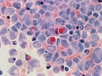 Leukemia is a group of disorder giving rise to uncontrolled, abnormal blood cells in the body(Unsplash) Leukemia is a group of disorder giving rise to uncontrolled, abnormal blood cells in the body(Unsplash)
