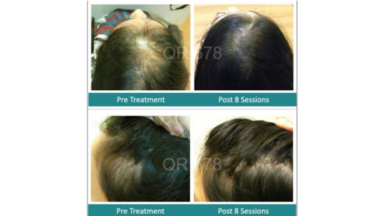 QR678 Hair Loss Treatment Patient Before After Results