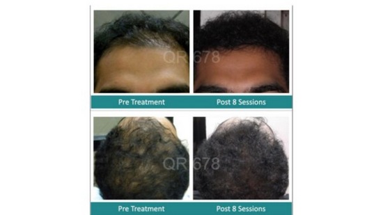 QR678 Hair Loss Treatment Patient Before After Results