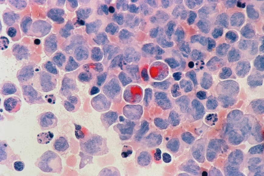 Leukemia is a group of disorder giving rise to uncontrolled, abnormal blood cells in the body (Unsplash)
