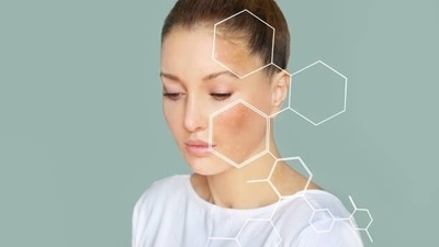 All you need to know about Hyperpigmentation All you need to know about Hyperpigmentation