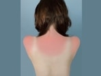 Sunburn: Tips to prevent yourself from the dangerous UV rays, avoid sunburn ((Twitter/romanticaugogo)) Sunburn: Tips to prevent yourself from the dangerous UV rays, avoid sunburn ((Twitter/romanticaugogo))