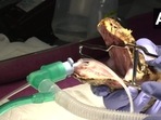 The rescued Indian rock python undergoing treatment. (ANI/ Twitter ) The rescued Indian rock python undergoing treatment. (ANI/ Twitter )