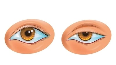 Ptosis: Causes, symptoms, treatments of droopy eyelids (Twitter/DollarJahan) Ptosis: Causes, symptoms, treatments of droopy eyelids (Twitter/DollarJahan)