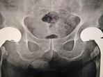 Hip fractures will double worldwide by 2050: Research