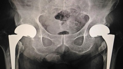 Hip fractures will double worldwide by 2050: Research (Shutterstock) Hip fractures will double worldwide by 2050: Research (Shutterstock)