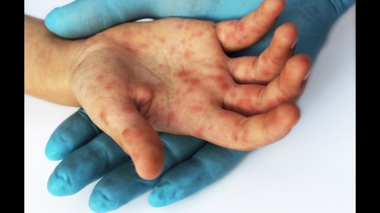 Hand, foot and mouth disease: Watch out for these symptoms; dos and don'ts(Shutterstock)