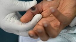 Monkeypox Death In US: The patient was severely immunocompromised.