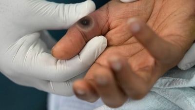 Monkeypox Death In US: The patient was severely immunocompromised. (AP/ Representational) Monkeypox Death In US: The patient was severely immunocompromised. (AP/ Representational)