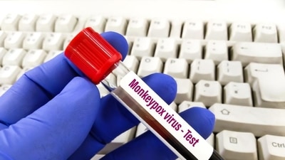 Second US monkeypox death as virus linked to brain inflammation. (Shutterstock) Second US monkeypox death as virus linked to brain inflammation. (Shutterstock)