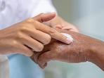 Skin health: Tips to control Atopic Dermatitis flare ups(Twitter/myCME) Skin health: Tips to control Atopic Dermatitis flare ups(Twitter/myCME)