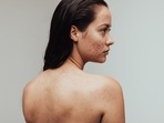 Bacne: What is it and how can you get rid of it