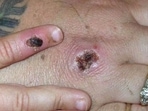 The woman has been admitted to LNJP Hospital,