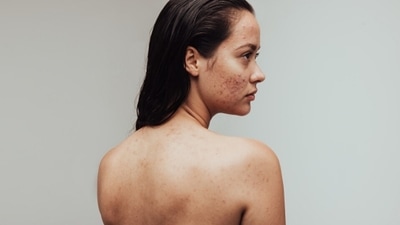 Bacne: What is it and how can you get rid of it (Unsplash)