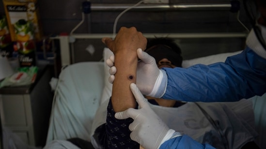 A doctor checks on a patient with sores caused by a monkeypox infection.(AFP)