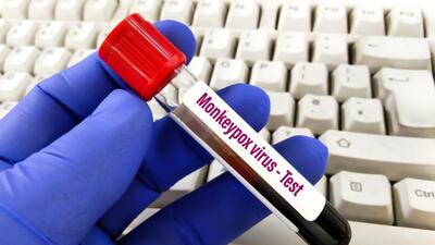 Monkeypox is a viral zoonosis (a virus transmitted to humans from animals) with symptoms similar to those in smallpox patients. (Shutterstock) Monkeypox is a viral zoonosis (a virus transmitted to humans from animals) with symptoms similar to those in smallpox patients. (Shutterstock)