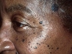 Seborrheic keratosis: Causes, symptoms, diagnosis and treatment of wart or mole-like benign skin tumours