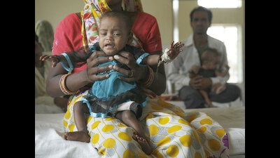 Pune zilla parishad’s child tracking system has listed as many as 116 children under severe acute malnutrition (SAM) and 723 moderate acute malnutrition (MAM). (REPRESENTATIVE IMAGE)