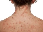 How skin diseases form differently across the body: Study How skin diseases form differently across the body: Study