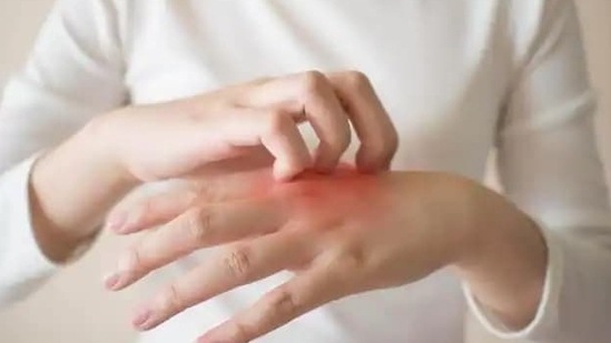 New drug to lower symptoms of severe eczema discovered by scientists