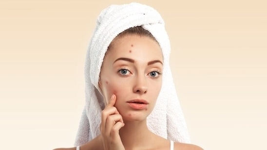 Period acne: Causes and tips to prevent it(freepik)