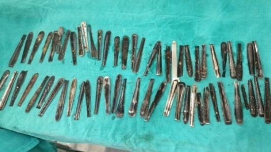 Docs took out 62 headless spoons from the patient's stomach and one from his intestine.