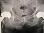 Underlying health issues linked to post-fracture outcomes in older adults: Study(Shutterstock) Underlying health issues linked to post-fracture outcomes in older adults: Study(Shutterstock)