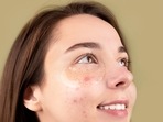 Do those pimple stickers or pimple patches actually work?(Anna Nekrashevich) Do those pimple stickers or pimple patches actually work?(Anna Nekrashevich)
