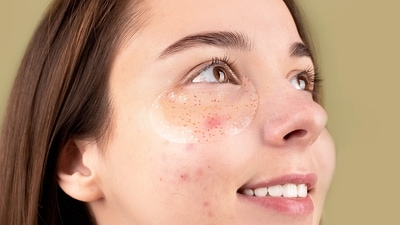 Do those pimple stickers or pimple patches actually work? (Anna Nekrashevich) Do those pimple stickers or pimple patches actually work? (Anna Nekrashevich)