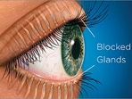 Meibomian Gland Dysfunction: Risk factors, symptoms and treatment of this eye condition(Twitter/joptoophthal) Meibomian Gland Dysfunction: Risk factors, symptoms and treatment of this eye condition(Twitter/joptoophthal)