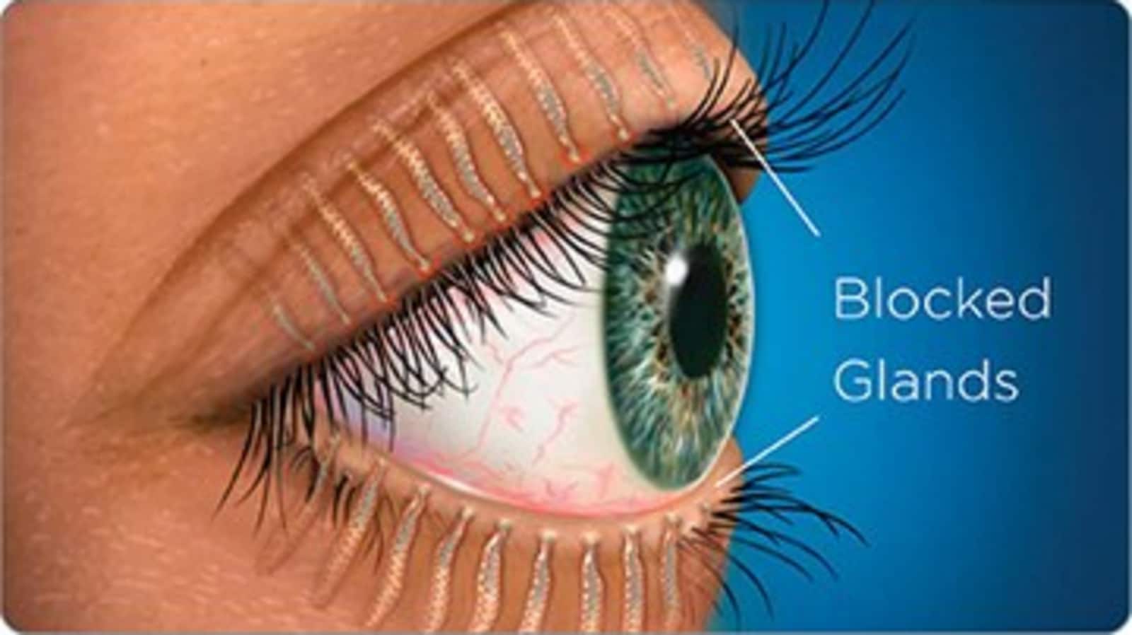 meibomian-gland-dysfunction-risk-factors-symptoms-and-treatment-of-this-eye-condition