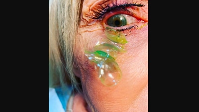 The image shows some of the contact lenses that the doctor removes from the woman's eye. (Instagram/@california_eye_associates)