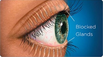 Meibomian Gland Dysfunction: Risk factors, symptoms and treatment of this eye condition (Twitter/joptoophthal) Meibomian Gland Dysfunction: Risk factors, symptoms and treatment of this eye condition (Twitter/joptoophthal)
