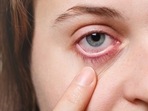 Eczema is a condition with dry itchy inflamed, scaly red skin.(Freepik) Eczema is a condition with dry itchy inflamed, scaly red skin.(Freepik)