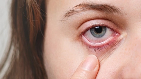 Eye eczema: What is eyelid dermatitis, know all about triggers, warning  signs