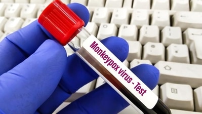 China has reported only one monkeypox case so far, in September, in a man who returned from abroad. (Shutterstock) China has reported only one monkeypox case so far, in September, in a man who returned from abroad. (Shutterstock)
