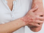 Psoriasis: Symptoms and treatment options 