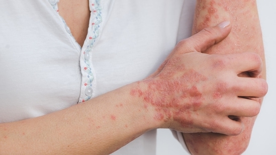 Psoriasis: Symptoms and treatment options