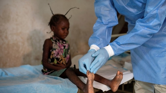 Monkeypox is a viral zoonotic disease that occurs primarily in tropical rainforest areas of central and west Africa and is occasionally exported to other regions.(Reuters)